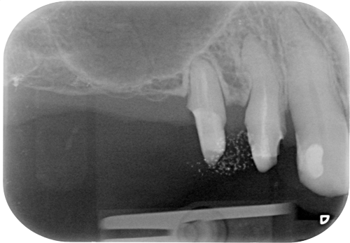 ancoraggio implantare dentale