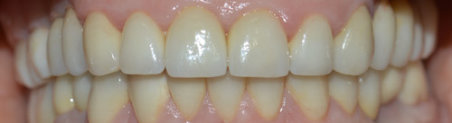 CORONE ZIRCONIO varese