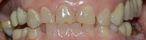 CORONE ZIRCONIO varese