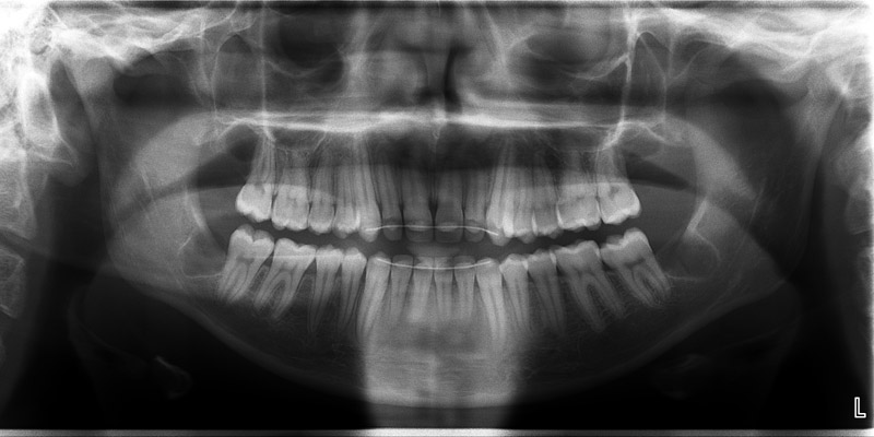 estrazione denti giudizio in unica seduta varese