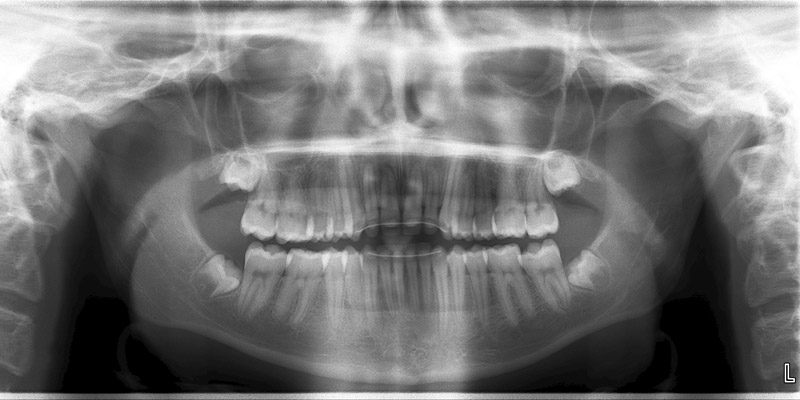 denti del giudizio estrazione a Varese