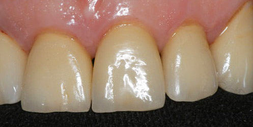 faccette dentali prima e dopo