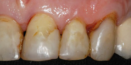 faccette dentali estetiche per difetti dello smalto