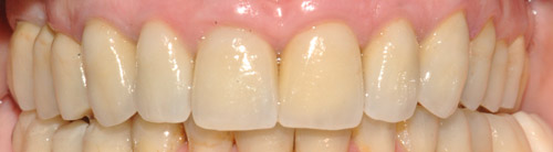  CORONE ZIRCONIO varese