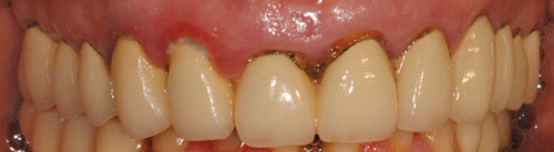 CORONE ZIRCONIO varese