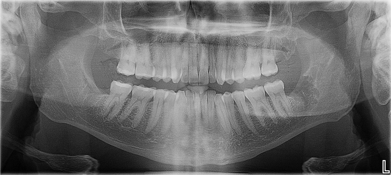 estrazione denti giudizio in unica seduta varese