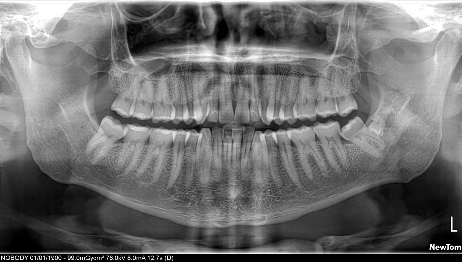 denti del giudizio estrazione a Varese