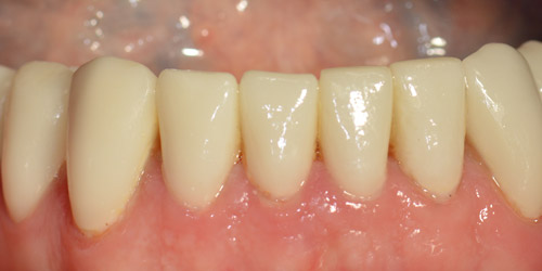 faccette zirconio per denti