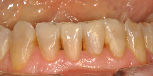 faccette dentali zirconio varese