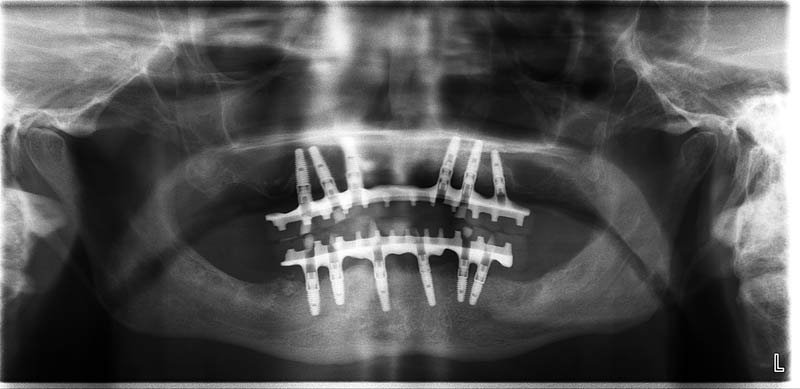 impianto dentale all on six | finito