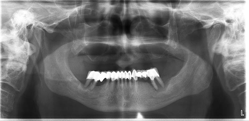 impianto dentale all on six | varese