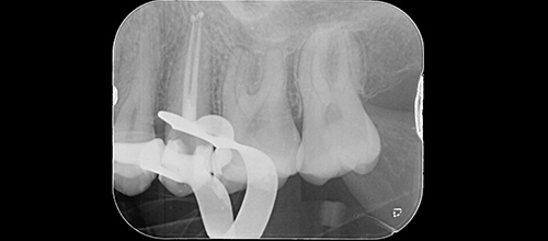 ENDODONZIA DEVITALIZZAZIONE - INTRAOPERATORIA. Studio dentistico dr. Azzalin varese