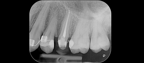 ENDODONZIA DEVITALIZZAZIONE - FINALE. Studio dentistico dr. Azzalin varese