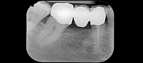 ENDODONZIA RITRATTAMENTO - INIZIALE. Studio dentistico dr. Azzalin varese
