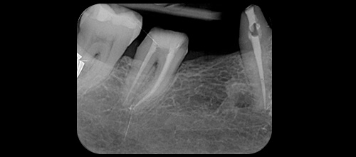 ENDODONZIA RITRATTAMENTO - FINALE. Studio dentistico dr. Azzalin varese