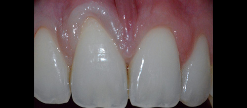 recessioni gengivali | studio dentistico dr. Dino Azzalin
