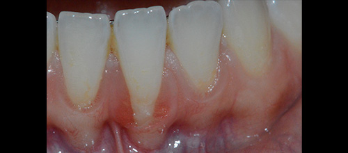 recessioni gengivali | studio dentistico dr. Dino Azzalin