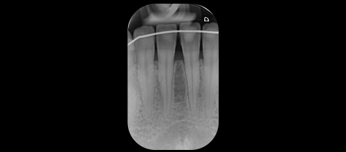 recessioni gengivali | studio dentistico dr. Dino Azzalin