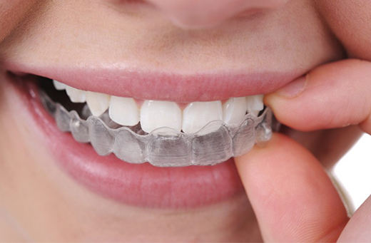 apparecchio denti trasparente invisalign