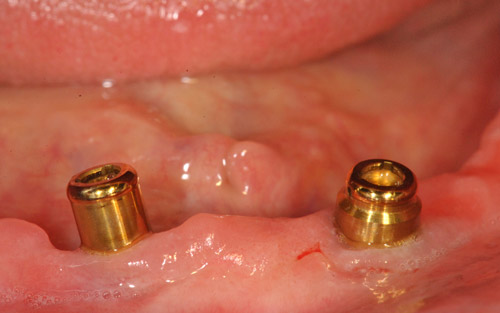 impianti dentali varese