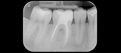 rigenerazione ossea guidata studio dentistico dr. Azzalin varese