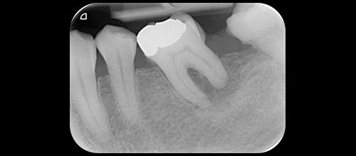 chirurgia parodontale resettiva studio dentistico dr. Azzalin varese