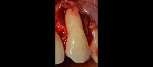 rigenerazione ossea guidata studio dentistico dr. Azzalin varese