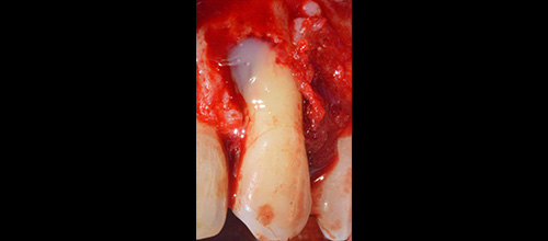 rigenerazione ossea guidata studio dentistico dr. Azzalin varese