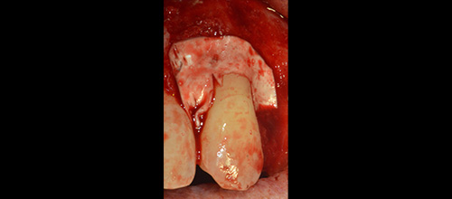 chirurgia parodontale resettiva studio dentistico dr. Azzalin varese