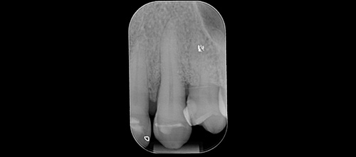 rigenerazione ossea guidata studio dentistico dr. Azzalin varese