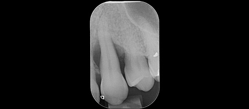 chirurgia parodontale rigenerazione studio dentistico dr. Azzalin varese
