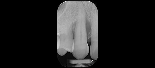 rigenerazione ossea guidata studio dentistico dr. Azzalin varese 