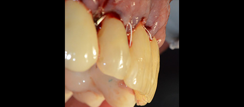 parodontologia correzione difetto osseo e riposizionamento chirurgico studio dentistico dr. Azzalin varese