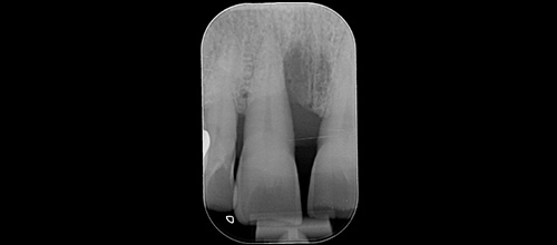 rparodontologia correzione difetto osseo e riposizionamento chirurgico studio dentistico dr. Azzalin varese