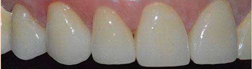 CORONE ZIRCONIO varese