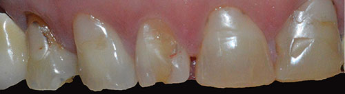 CORONE ZIRCONIO varese