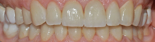  CORONE ZIRCONIO varese