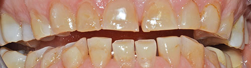 CORONE ZIRCONIO varese